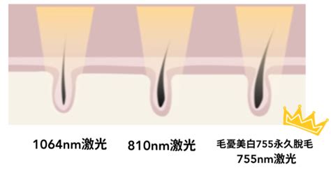 激光脫陰毛|激光脫毛懶人包：無死角永久除毛，跟毛毛說再見！